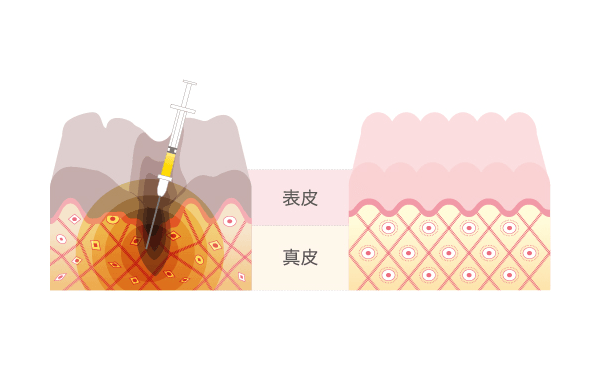 表皮 真皮